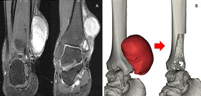 Case Report: Reconstruction of Medialis Malleolus (1/4 of the Ankle Joint) After Resection of Distal Tibia Tumor With an Uncemented Three-Dimensional-Printed Prosthesis